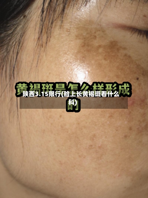 陕西3.15限行(脸上长黄褐斑看什么科)